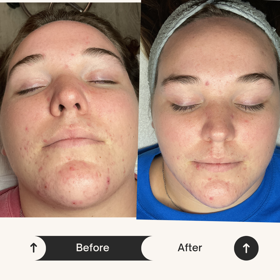 Skincare Before and After Transformation